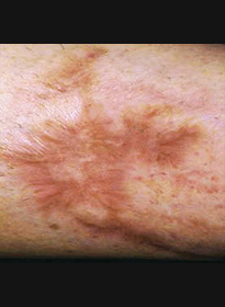 Scar-Removal-before-2 Houston Wellness & Aesthetics|Before and After Gallery