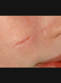 Scar-Removal-before-3 Houston Wellness & Aesthetics|Before and After Gallery