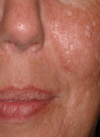 Scar-Removal-before-4 Houston Wellness & Aesthetics|Before and After Gallery