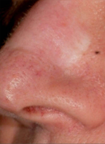 Scar-Removal-before-5 Houston Wellness & Aesthetics|Before and After Gallery