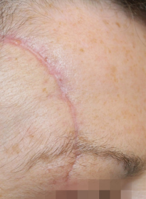 Scar-Removal-before Houston Wellness & Aesthetics|Before and After Gallery