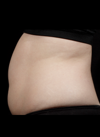 SculpSure-after-10 Houston Wellness & Aesthetics|Before and After Gallery