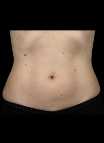 SculpSure-after-11 Houston Wellness & Aesthetics|Before and After Gallery