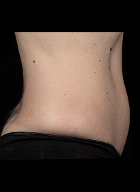 SculpSure-after-12 Houston Wellness & Aesthetics|Before and After Gallery