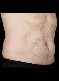 SculpSure-after-13 Houston Wellness & Aesthetics|Before and After Gallery