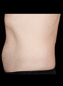 SculpSure-after-14 Houston Wellness & Aesthetics|Before and After Gallery