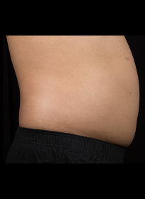 SculpSure-after-15 Houston Wellness & Aesthetics|Before and After Gallery