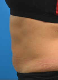 SculpSure-after-16 Houston Wellness & Aesthetics|Before and After Gallery