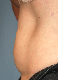 SculpSure-after-17 Houston Wellness & Aesthetics|Before and After Gallery