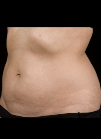 SculpSure-after-18 Houston Wellness & Aesthetics|Before and After Gallery