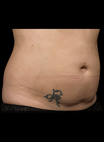 SculpSure-after-19 Houston Wellness & Aesthetics|Before and After Gallery