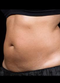 SculpSure-after-20 Houston Wellness & Aesthetics|Before and After Gallery