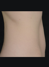 SculpSure-after-21 Houston Wellness & Aesthetics|Before and After Gallery