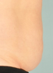 SculpSure-after-22 Houston Wellness & Aesthetics|Before and After Gallery