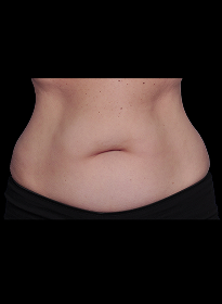 SculpSure-after-23 Houston Wellness & Aesthetics|Before and After Gallery
