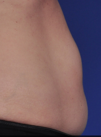 SculpSure-after-24 Houston Wellness & Aesthetics|Before and After Gallery