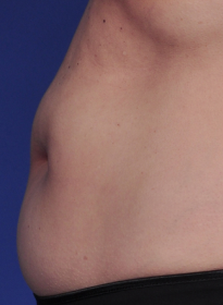 SculpSure-after-25 Houston Wellness & Aesthetics|Before and After Gallery