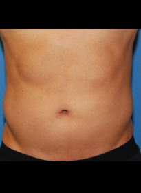 SculpSure-after-26 Houston Wellness & Aesthetics|Before and After Gallery