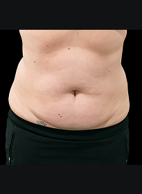 SculpSure-after-27 Houston Wellness & Aesthetics|Before and After Gallery