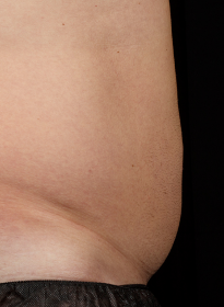 SculpSure-after-28 Houston Wellness & Aesthetics|Before and After Gallery