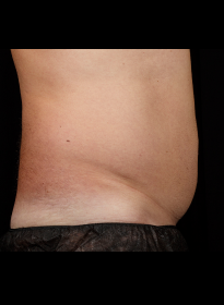 SculpSure-after-29 Houston Wellness & Aesthetics|Before and After Gallery