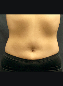 SculpSure-after-30 Houston Wellness & Aesthetics|Before and After Gallery