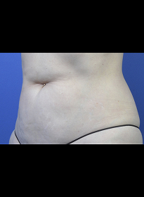 SculpSure-after-31 Houston Wellness & Aesthetics|Before and After Gallery