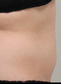 SculpSure-after-32 Houston Wellness & Aesthetics|Before and After Gallery