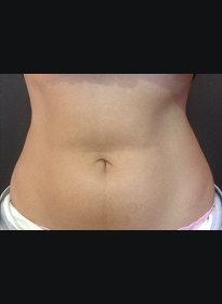 SculpSure-after-33 Houston Wellness & Aesthetics|Before and After Gallery