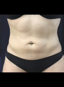 SculpSure-after-34 Houston Wellness & Aesthetics|Before and After Gallery