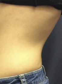 SculpSure-after-35 Houston Wellness & Aesthetics|Before and After Gallery