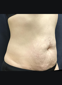 SculpSure-after-36 Houston Wellness & Aesthetics|Before and After Gallery