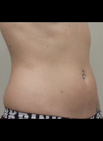 SculpSure-after-37 Houston Wellness & Aesthetics|Before and After Gallery