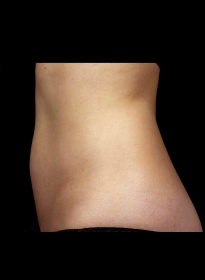 SculpSure-after-38 Houston Wellness & Aesthetics|Before and After Gallery