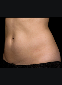 SculpSure-after-39 Houston Wellness & Aesthetics|Before and After Gallery