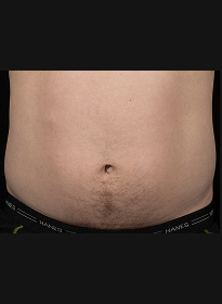 SculpSure-after-4 Houston Wellness & Aesthetics|Before and After Gallery