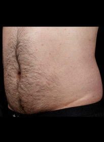 SculpSure-after-40 Houston Wellness & Aesthetics|Before and After Gallery