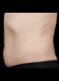 SculpSure-after-41 Houston Wellness & Aesthetics|Before and After Gallery