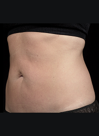 SculpSure-after-42 Houston Wellness & Aesthetics|Before and After Gallery