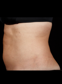 SculpSure-after-43 Houston Wellness & Aesthetics|Before and After Gallery