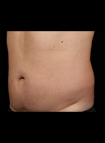 SculpSure-after-44 Houston Wellness & Aesthetics|Before and After Gallery