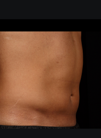 SculpSure-after-45 Houston Wellness & Aesthetics|Before and After Gallery