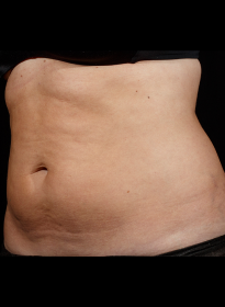 SculpSure-after-46 Houston Wellness & Aesthetics|Before and After Gallery