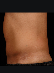 SculpSure-after-48 Houston Wellness & Aesthetics|Before and After Gallery