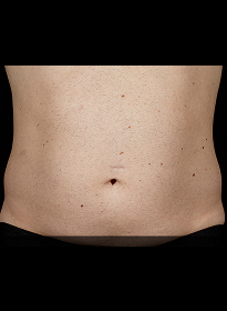 SculpSure-after-5 Houston Wellness & Aesthetics|Before and After Gallery