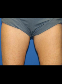 SculpSure-after-50 Houston Wellness & Aesthetics|Before and After Gallery