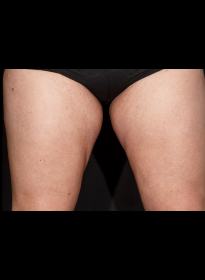 SculpSure-after-51 Houston Wellness & Aesthetics|Before and After Gallery