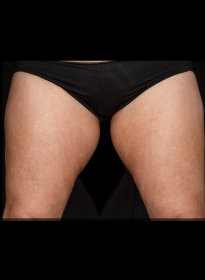 SculpSure-after-53 Houston Wellness & Aesthetics|Before and After Gallery