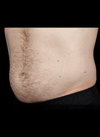 SculpSure-after-6 Houston Wellness & Aesthetics|Before and After Gallery