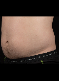 SculpSure-after-7 Houston Wellness & Aesthetics|Before and After Gallery